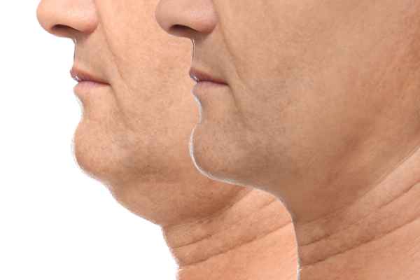 HIFU - Breakthrough in Anti - ageing 2 hifu results Leighton Buzzard