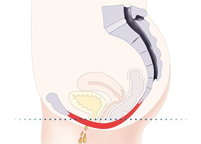 Pelvic-Floor Muscle Repair 5 Pelvic floor muscles Leighton Buzzard