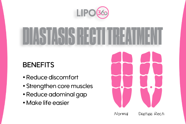 Revolutionising Muscle Repair: The Power of LIPO360 Body Sculpt Post-Injury 5 diastasis recti treatment Leighton Buzzard