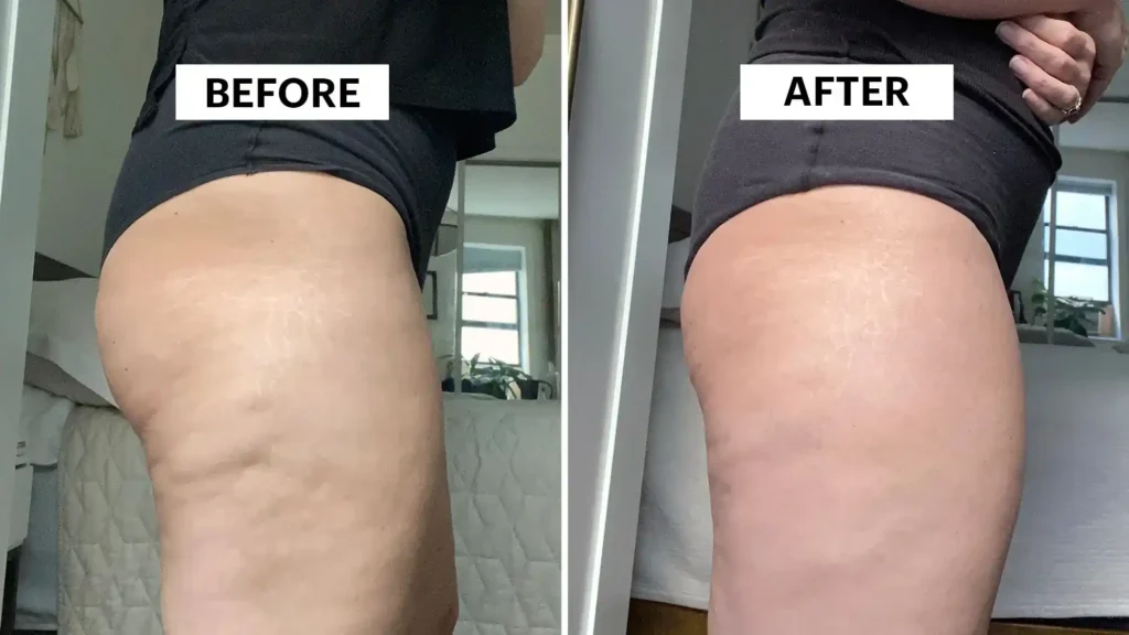 Sculpting Your Bum: Can Toning Exercises Really Reduce Cellulite? 1 Do Toning Exercise Leighton Buzzard Really Tackle Cellulite?