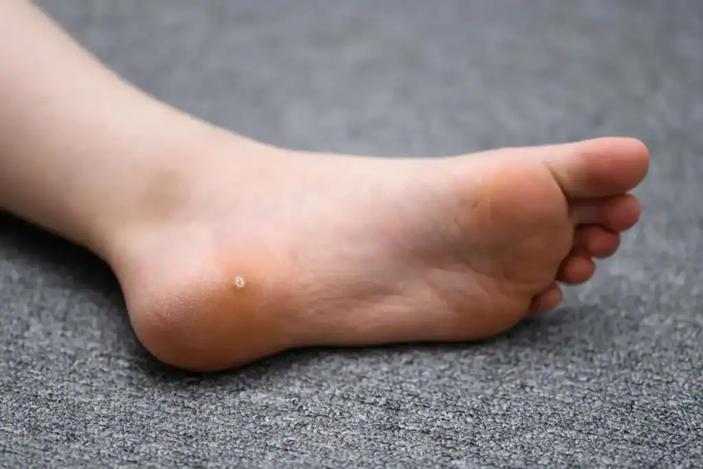 Cryotherapy For Warts And Also Verrucas 2 Image of verruca on the bottom of the foot that able to be treated with Cryotherapy Leighton Buzzard