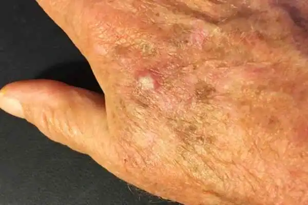 Cryopen For Actinic Keratoses 1 Image of Actinic keratoses Leighton Buzzard on a person hand